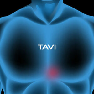 tavi